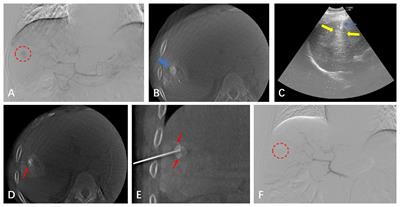 TACE-assisted multi-image guided radiofrequency ablation for the treatment of single hepatocellular carcinoma ≤ 5 cm: a retrospective study